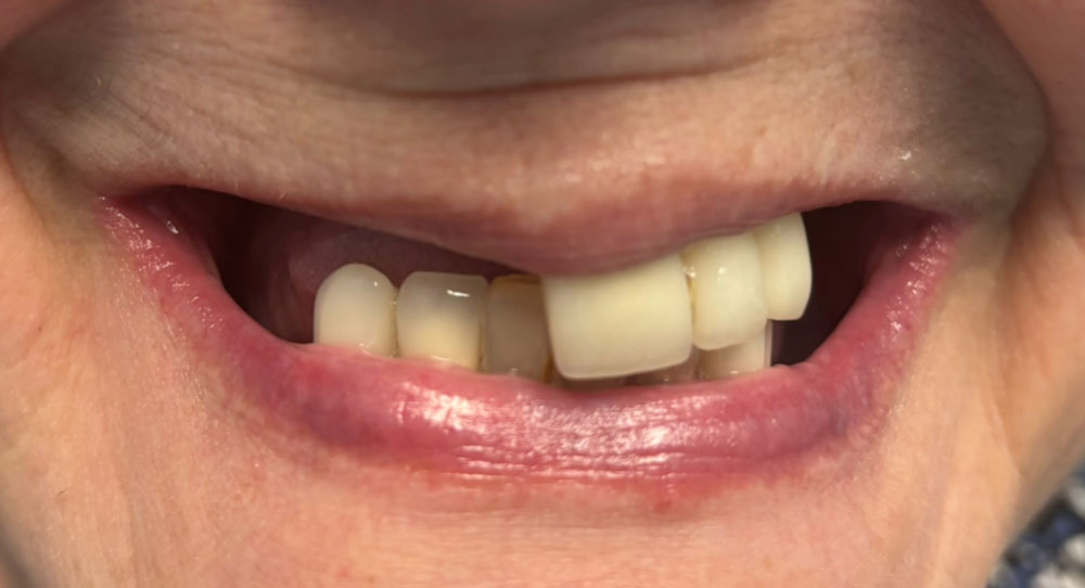 dentures-0123-before